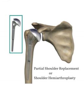 Partial Shoulder Replacement - Dr Lingaraju