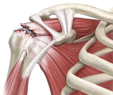 Arthroscopic Rotator Cuff Repair - Dr Lingaraju